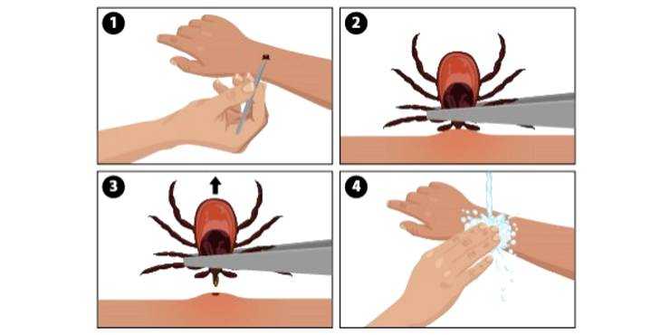 Tick Removal